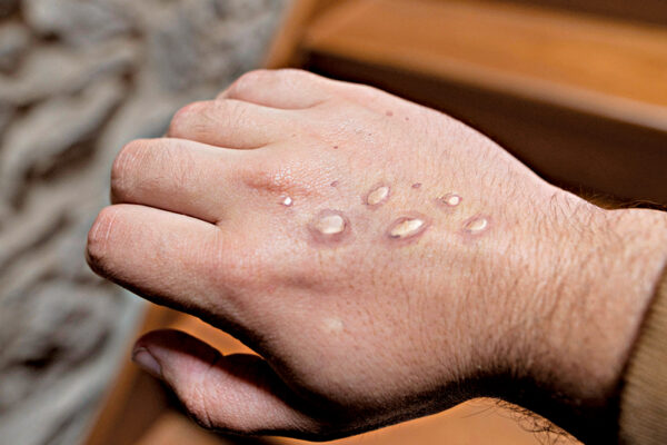 Monkey Pox: Key Facts