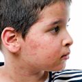 Measles Outbreak - News for Kids
