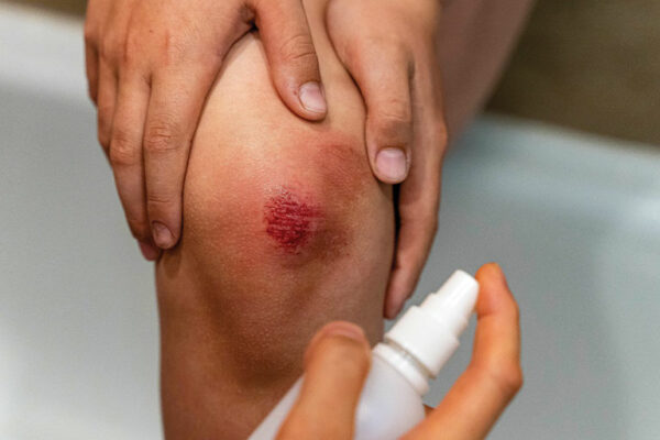 Healing Wounds Quickly